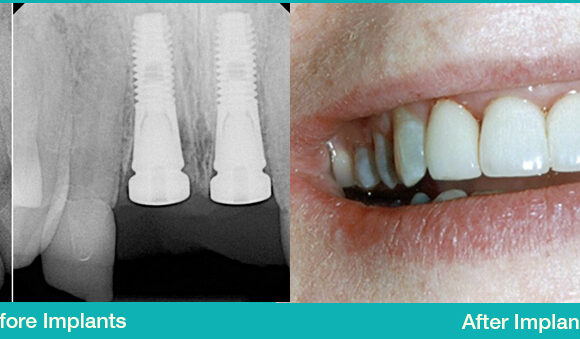 Dental Implants