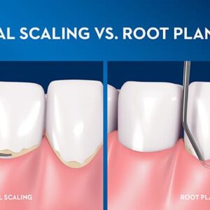 Scaling/Root Planing and Periodontal Maintenance