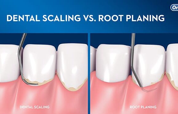 Scaling/Root Planing and Periodontal Maintenance