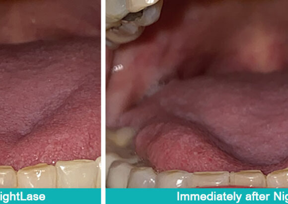 NightLase-Before-and-After