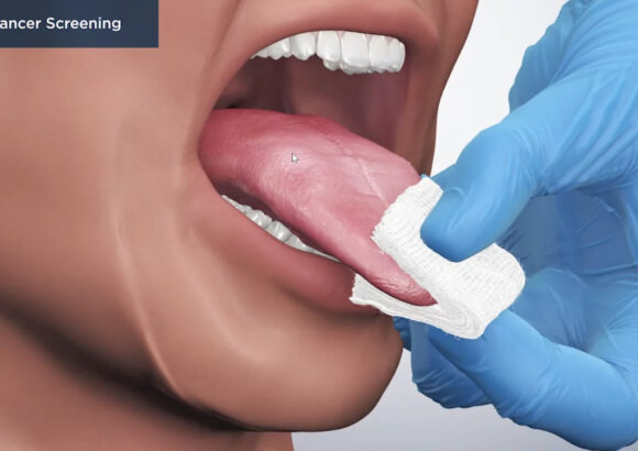 Oral Cancer Screening and Oral Pathology